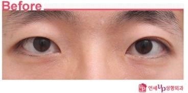 연세UP성형외과 쌍수 앞트임 연세Up성형외과 쌍수 앞트임