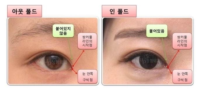 연세UP성형외과 쌍수 앞트임 연세Up성형외과 쌍수 앞트임