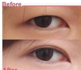 연세UP성형외과 쌍수 앞트임 연세Up성형외과 쌍수 앞트임