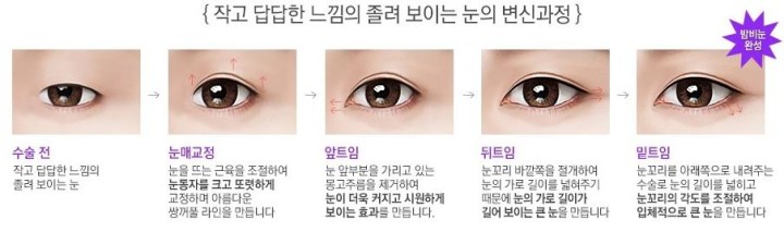 밤비눈성형 아이디병원 밤비눈성형 아이디병원