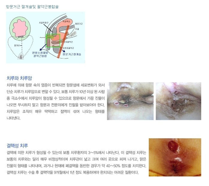 치루 및 항문주위농양 대장항문전문 강남송도외과