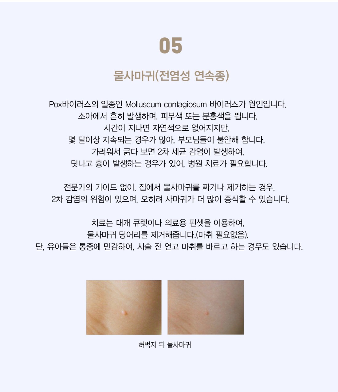 사마귀치료, 벧엘피부과전문의