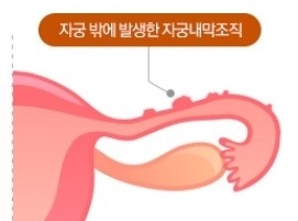 자궁내막증 | 자윤한의원 분당점 자궁내막증 | 자윤한의원 분당점