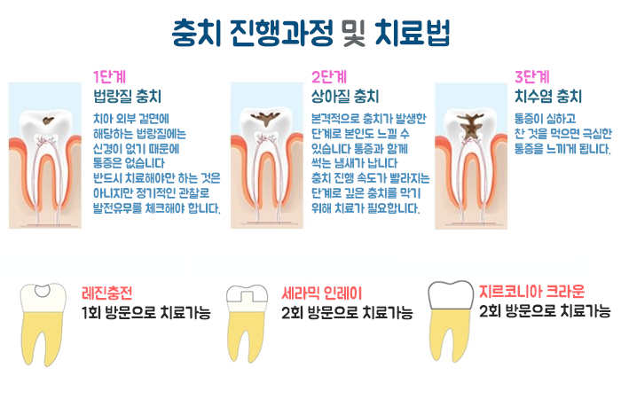 충치치료 | 울산 타임치과 충치치료 | 울산 타임치과