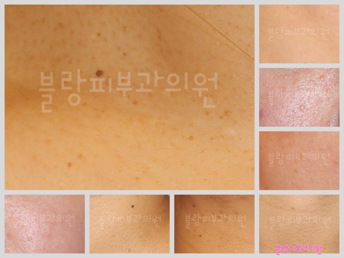 블랑피부과 블랑피부과의원 블랑피부과 블랑피부과의원