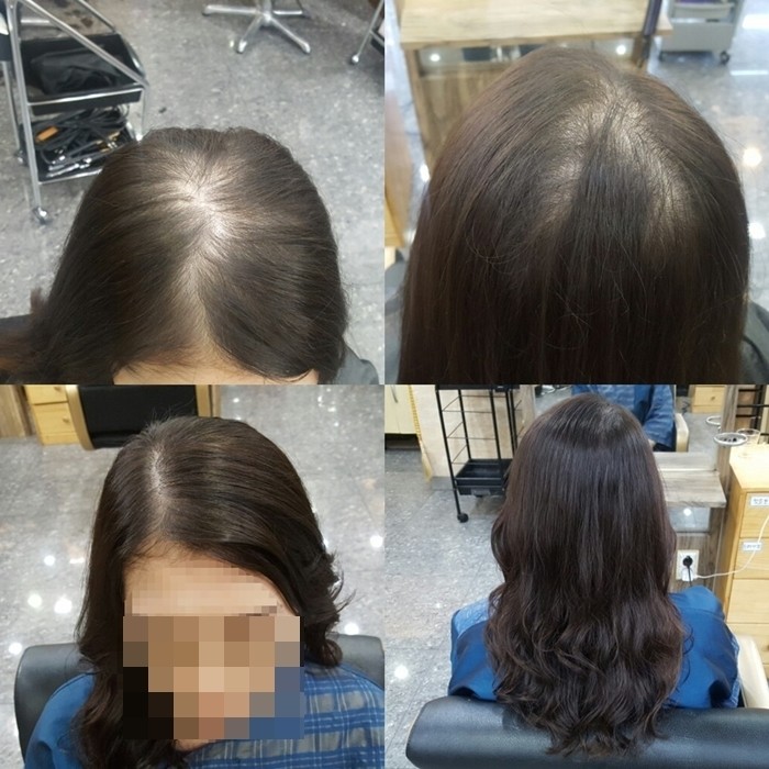 20대여성탈모 | 이진뷰티 20대여성탈모 | 이진뷰티