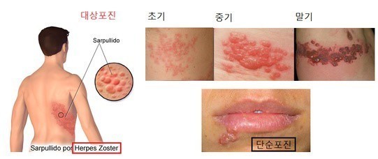 사진은 대상포진의 증상으로 피부에 물집이 생긴 모습이다. 사진은 대상포진의 증상으로 피부에 물집이 생긴 모습이다.