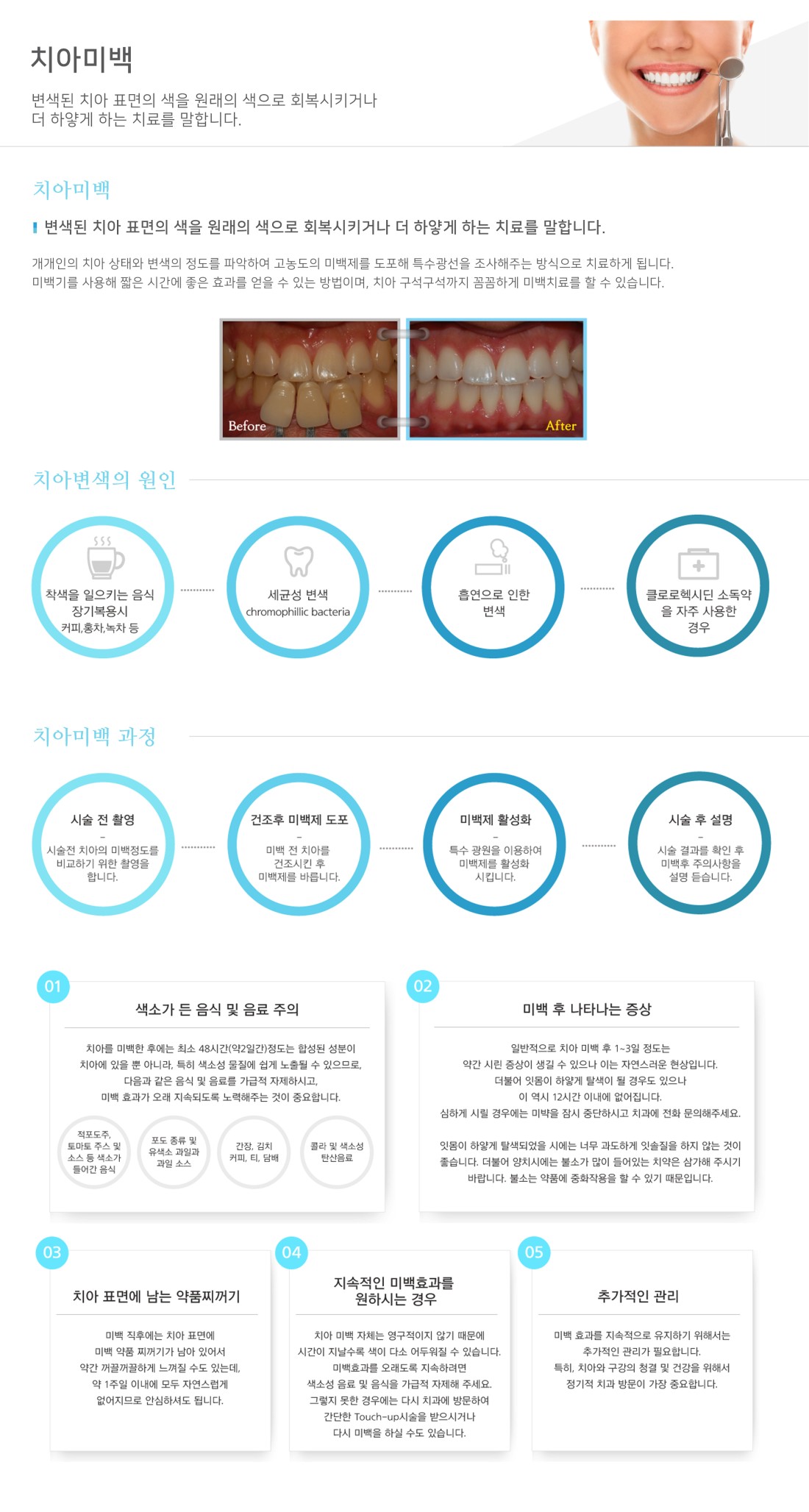 치아미백 | 구로좋은치과 치아미백 | 구로좋은치과
