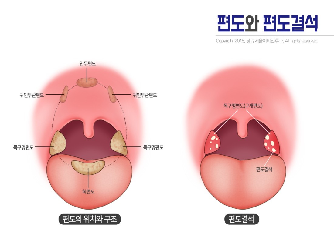 [공지] [치료/수술/개선] 편도절제술후기 꽃이비인후과 편도 절제 입원 수술 퇴원 후기