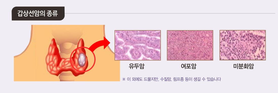 갑상선 낭포의 종류별 원인과 증상은? | 다산갑상선