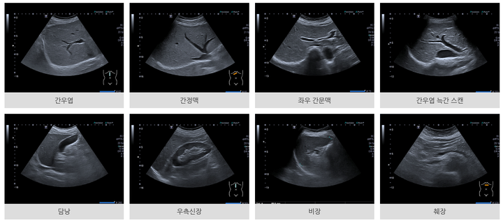 [상왕십리 복부 초음파] 서울우툼내과 복부초음파 진단받은 간경변
