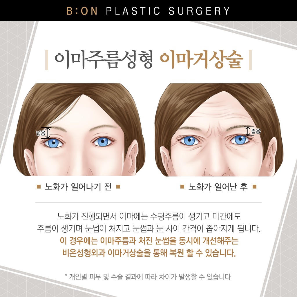 비온성형외과 주름성형 비온성형외과 주름성형