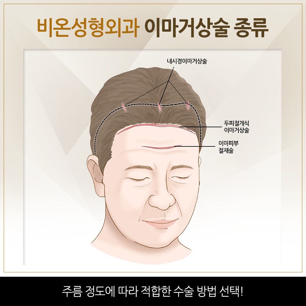 비온성형외과 주름성형 비온성형외과 주름성형