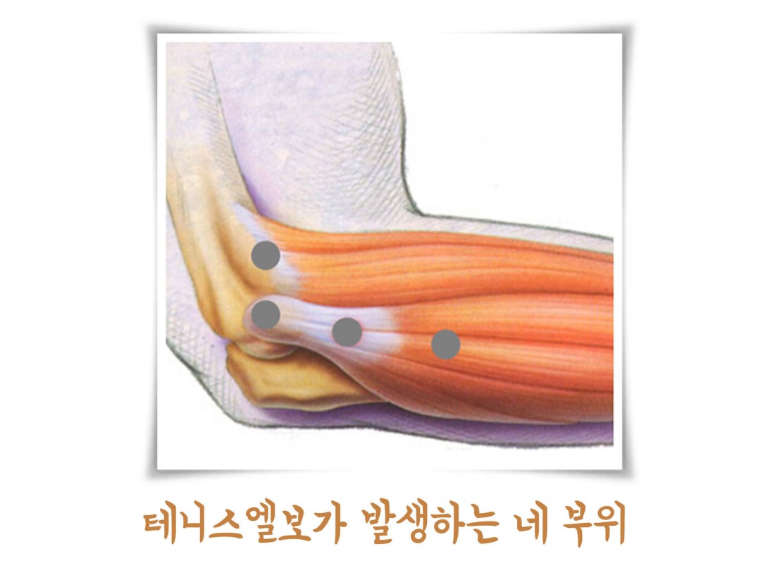 팔꿈치 통증 | 성모메트로정형외과 의원