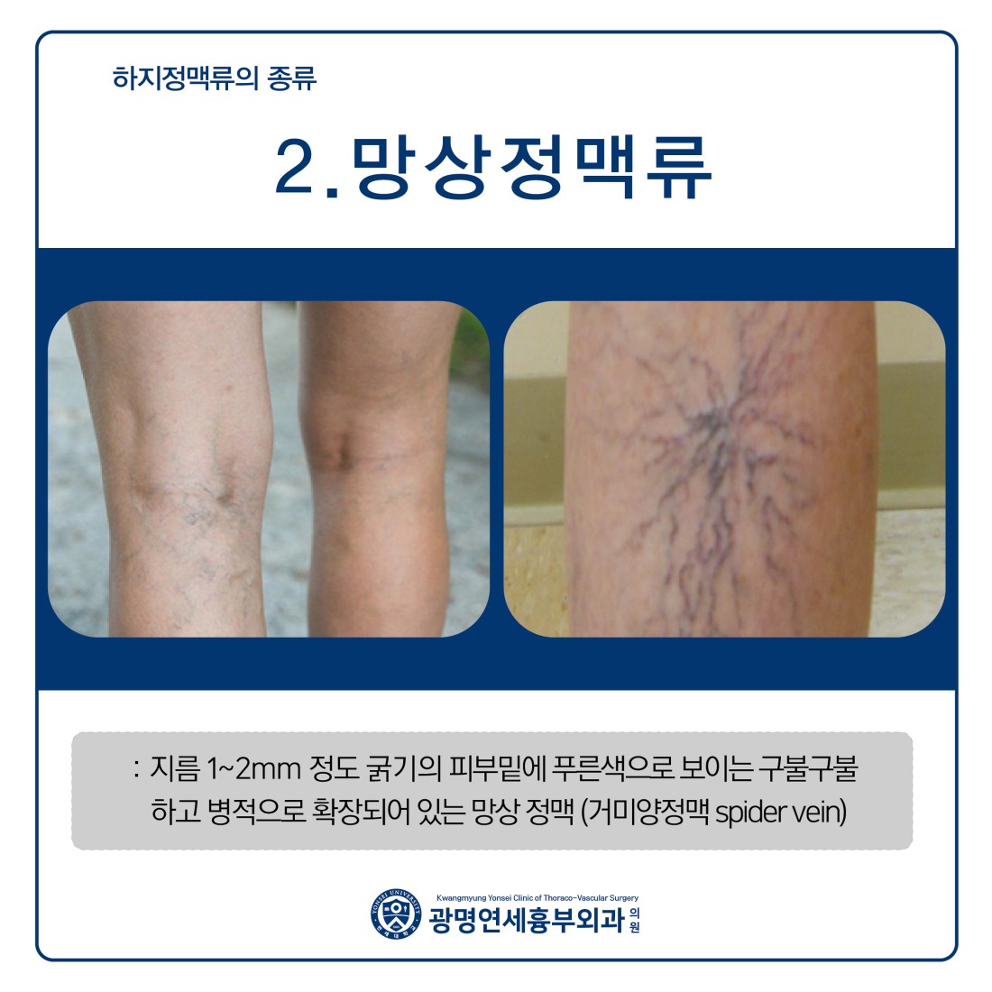 [광명하지정맥류] 하지정맥류 바늘로 찌르는 것처럼 다리가 시큰할 때