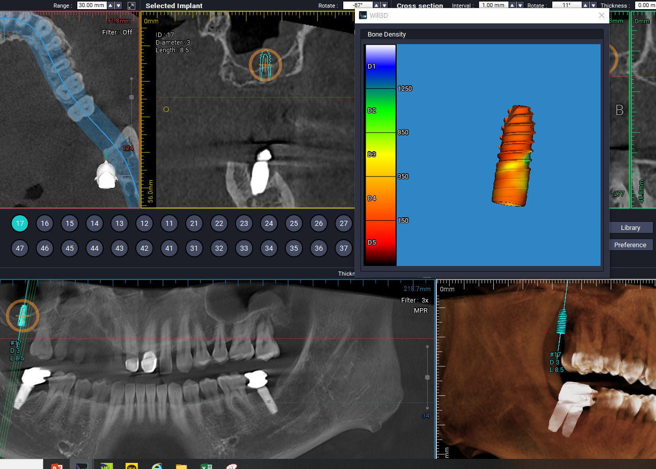 저선량 Dental CT-개포동치과 / 연세예은치과