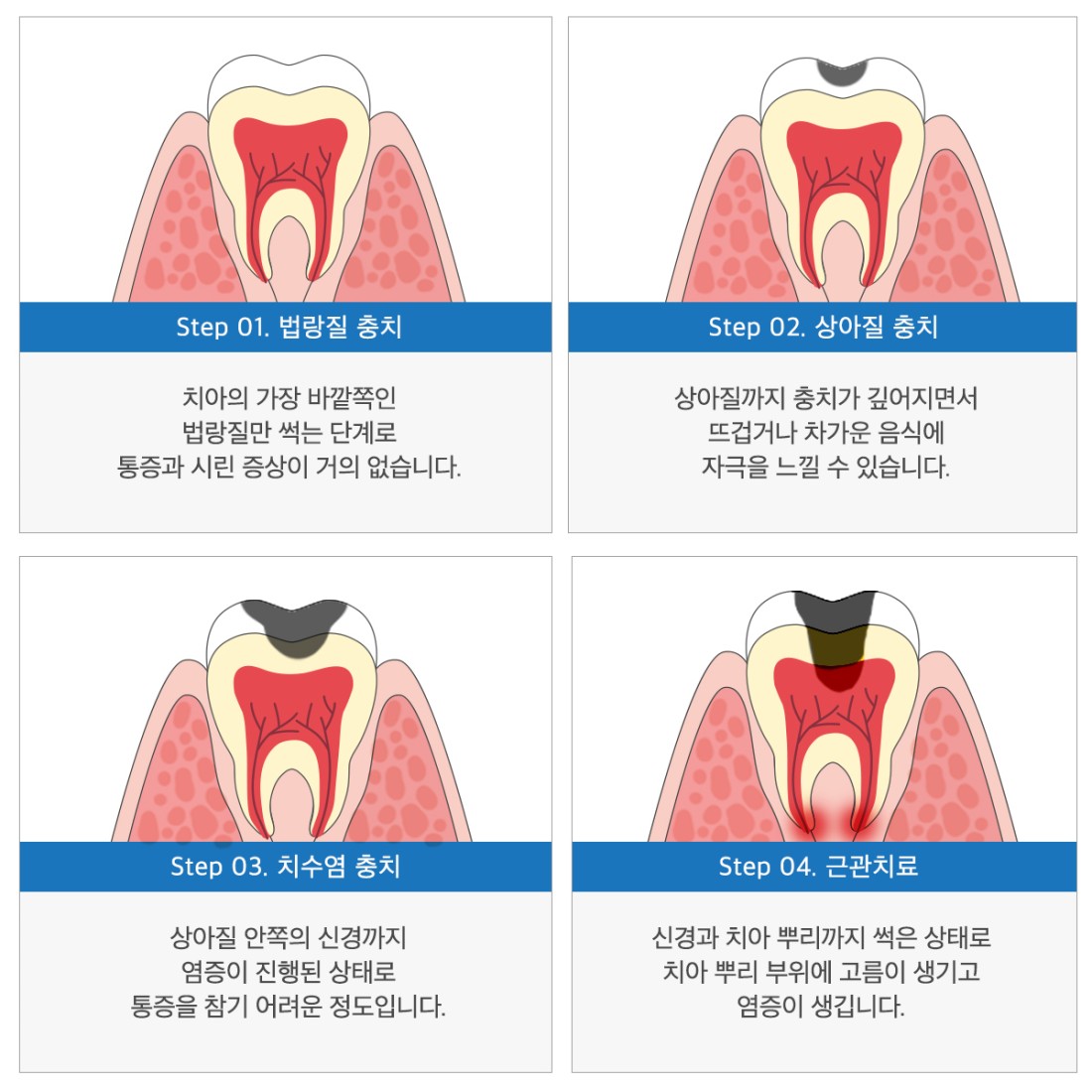충치치료 | 연경S치과의원 충치치료 | 연경S치과의원
