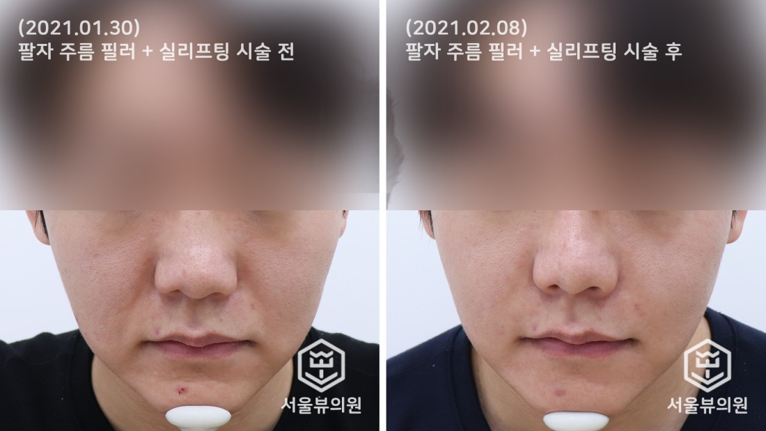대전유성구피부과 팔자주름필러