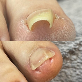 은평구 발톱무는 좀 까다롭긴 한데 관리하셔야 해요.
