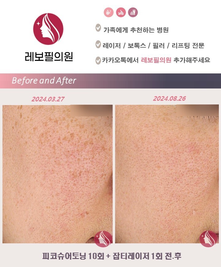 피부 시술전·후-레보필의원